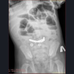 Из кишечника ребенка хирурги детской больницы № 1 извлекли 25 магнитиков