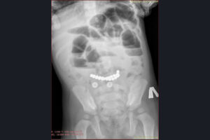 Из кишечника ребенка хирурги детской больницы № 1 извлекли 25 магнитиков